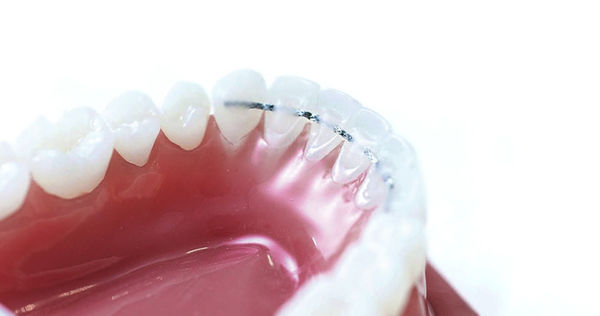 La meilleure fixation possible et la protection la plus sûre contre les récidives est un petit fil d’arc collé derrière les dents, dits Retainer. 