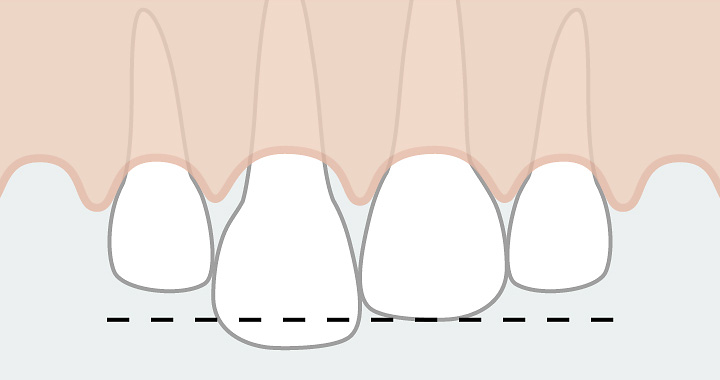 La maladie parodontale peut entraîner des dents mal alignées