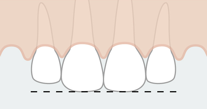 Un désalignement dentaire peut également être déclenché par une maladie parodontale