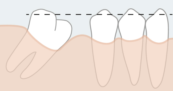 Avant l’intégration réelle de la prothèse dentaire, la réhabilitation globale des dents joue un rôle important.