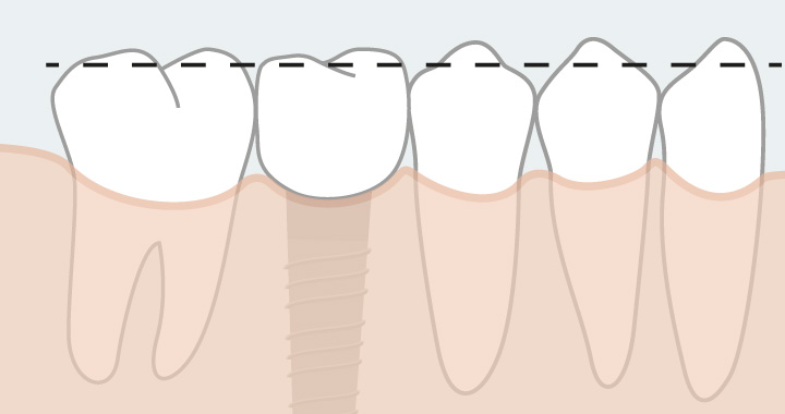 Un traitement orthodontique pour améliorer sensiblement la position des dents afin d’assurer la bonne adaptation des travaux prothétiques.