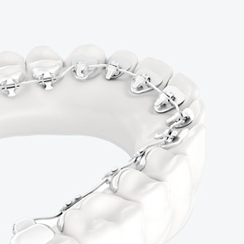 Les appareils linguales sont attachées à l'intérieur des dents