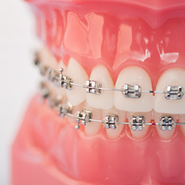 Les appareils dentaires fixes poussent les dents dans la bonne position